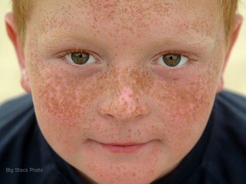 Freckles